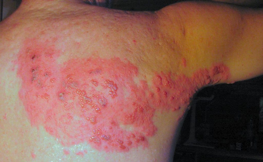 El herpes zóster es una enfermedad que afecta 1 de cada 3 adultos mayores de 50 años, pero también a personas menores con sistema inmune comprometido.