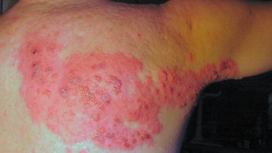 El herpes zóster es una enfermedad que afecta 1 de cada 3 adultos mayores de 50 años, pero también a personas menores con sistema inmune comprometido.