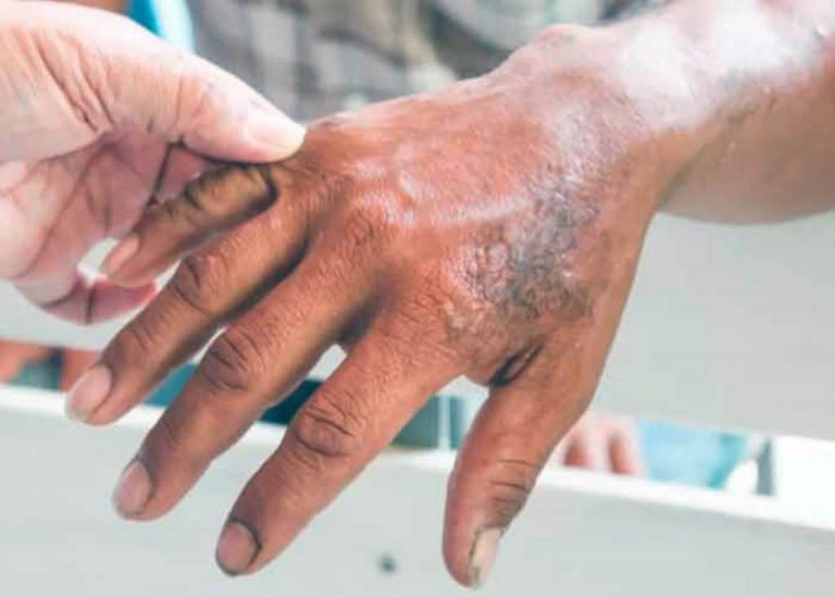 Mano de paciente con Lepra.