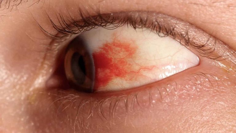 Retinopatía diabética.